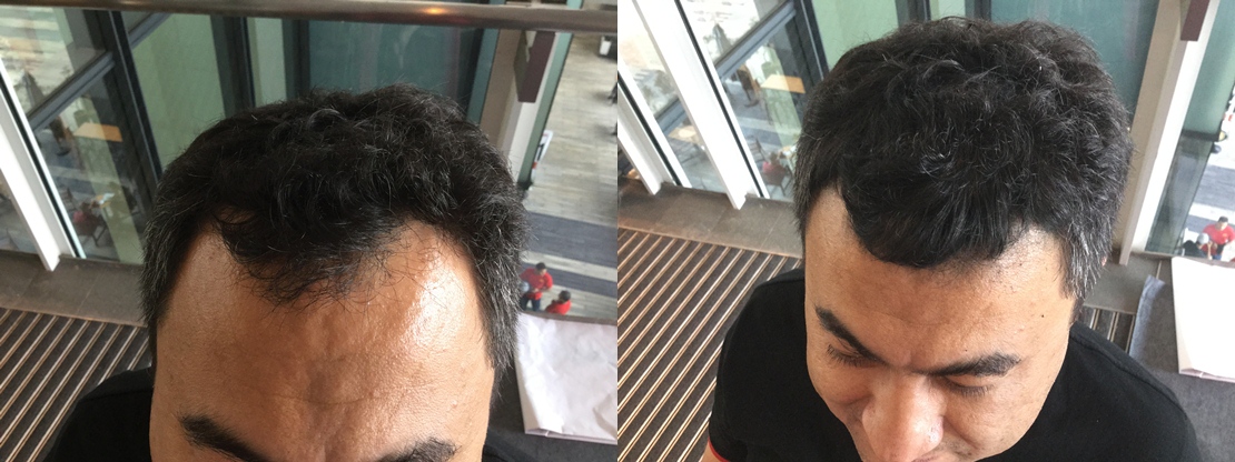 masalah rambut gugur siap diatasi segera